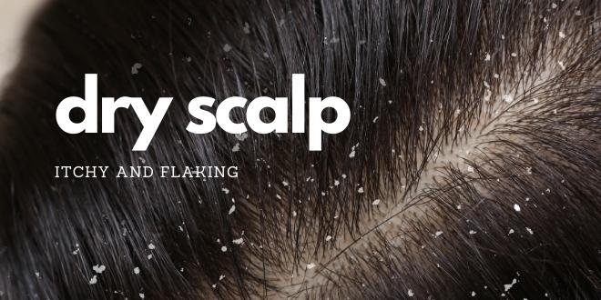 dry scalp with dandruff